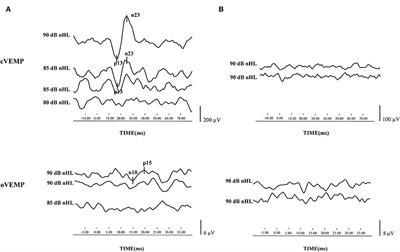 Vestibular evoked myogenic potential may predict the hearing recovery in patients with unilateral idiopathic sudden sensorineural hearing loss